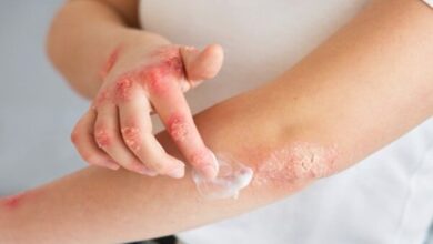 اگزما از کجا آمده و چگونه می توان آن را مهار کرد؟ - آژانس خبری مهر ایرانی و اخبار جهانی