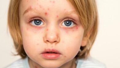 نگاه کنید به | اگر به عنوان یک کودک آبله ای مصرف نکرده اید ...