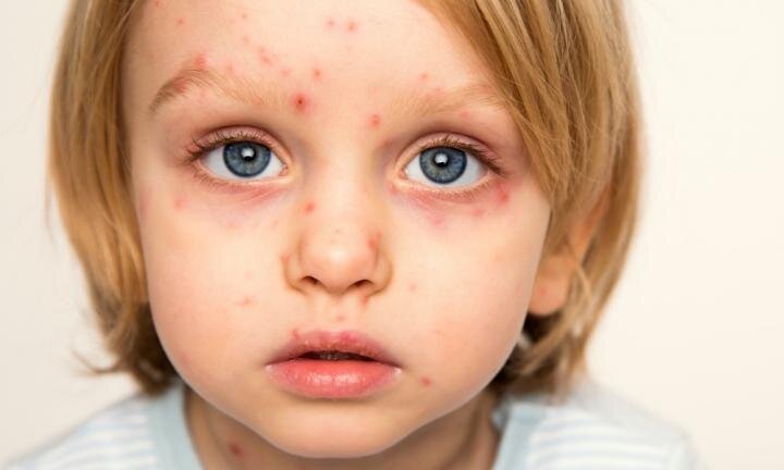 آبله در بزرگسالان چقدر خطرناک است؟