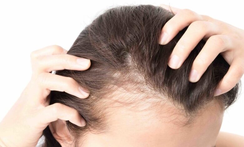 تصورات غلط در مورد ریزش مو/ درمان های طبیعی برای ریزش مو چقدر مؤثر است؟