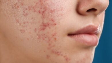 آکنه خطر ابتلا به اختلالات خوردن در بزرگسالی را افزایش می دهد - خبرگزاری مهر | اخبار ایرانی و جهانی