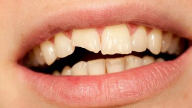 چرا دندانها زود پوسیده می شوند؟