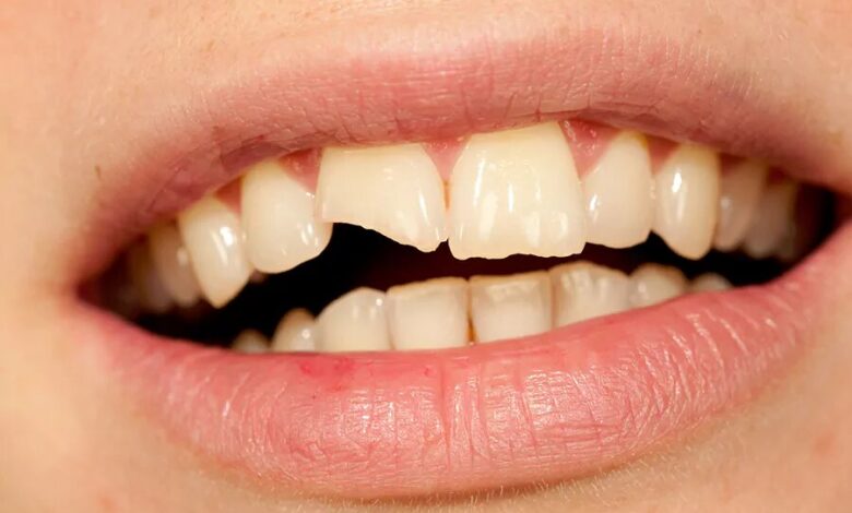 چرا دندانها زود پوسیده می شوند؟