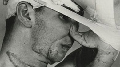 تاریخچه جراحی های زیبایی/ استفاده از پوست پیشانی برای ترمیم برش بینی در مجازات ها/ چه زمانی اولین جراحی زیبایی در تاریخ بود؟