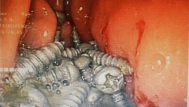 حذف پیچ های تیز از معده بیمار در Karaj/ عکس