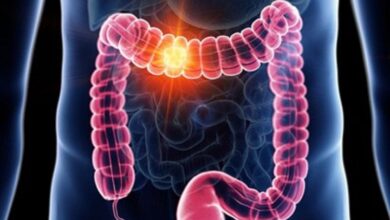 علائم اولیه سرطان روده بزرگ چیست؟