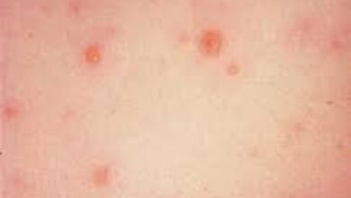 آیا بیماری بهاری آبله مرغان است؟