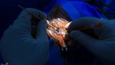 دستاورد جدید در بیمارستان فارابی؛ پیوند عصب قرنیه از ساق پا