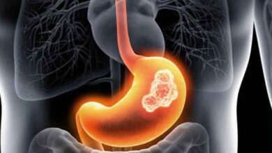 سرطان معده شایع‌ترین سرطان گوارشی در ایران