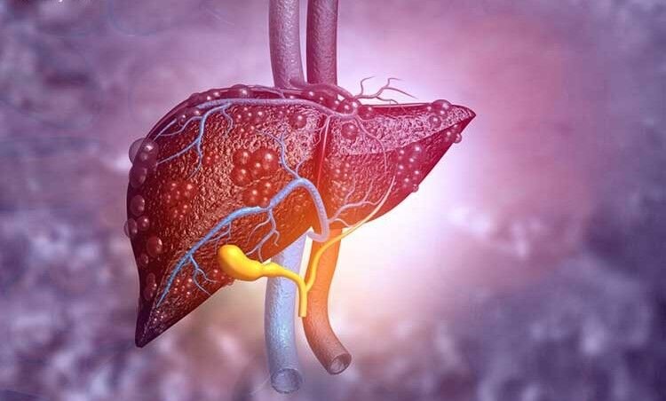 بدترین غذاها برای بیماری کبد چرب