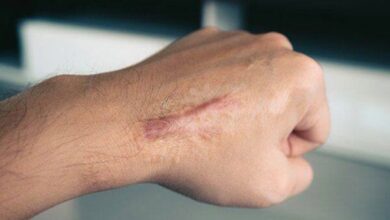 راه های درمان Cloide - آژانس خبری Mehr | اخبار ایرانی و جهانی