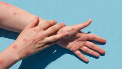 آبله مرغان و مراقبت از آن