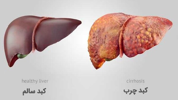 چگونه کبد چرب تهیه کنیم؟/ غذاهای مفید و مضر برای کبد