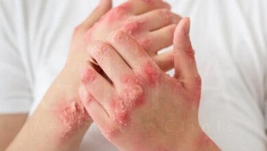 ارتباط چربی شکمی با بیماری پوستی پسوریازیس - آژانس خبری مهر | اخبار ایرانی و جهانی