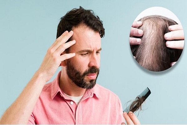 دلیل ریزش مو سکه چیست؟ - آژانس خبری مهر ایرانی و اخبار جهانی