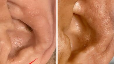 چین های لاله گوش در مورد یک بیماری/ عکس مهم آگاه هستند