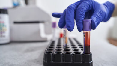 چرا آزمایشAMH انجام می شود؟