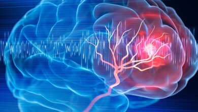 سکته مغزی و ثانیه های طلایی زندگی