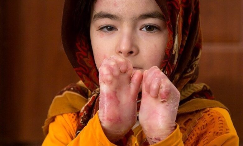 پانسمان تخصصی بیماران پروانه تحویل داده شد - آژانس خبری مهر | اخبار ایرانی و جهانی