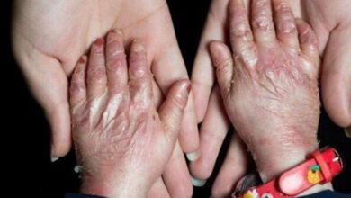 بیماری پروانه چیست؟ درمان EB + هزینه درمان EBB | بیمارستان سید الشوهادا در یزد