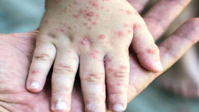 سرخک در ایالات متحده در 5 سال گذشته به بالاترین سطح خود رسید - آژانس خبری مهر | اخبار ایرانی و جهانی