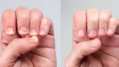 آیا سفیدی ناخن نشانه کم خونی است - آژانس خبری مهر | اخبار ایرانی و جهانی