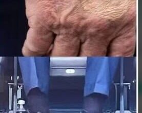 بیماری ترامپ چیست؟ چرا رئیس جمهور ایالات متحده تسمه کفش خود را بست؟