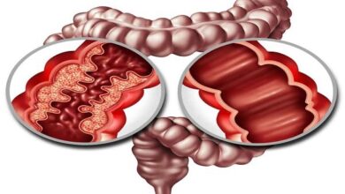 داروهای رایج مربوط به بیماری التهابی روده نیست - خبرگزاری مهر | اخبار ایرانی و جهانی