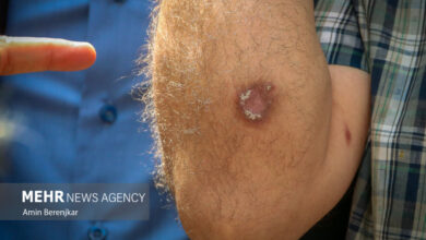 کاهش لیشمانیوز در دامگان ؛ آمار این روند رو به پایین است - آژانس خبری مهر | اخبار ایرانی و جهانی