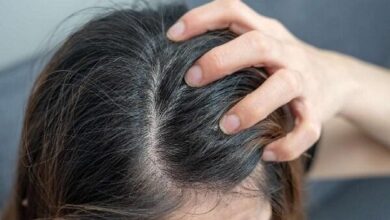 اگزما پوست سر چیست و چگونه درمان می شود؟