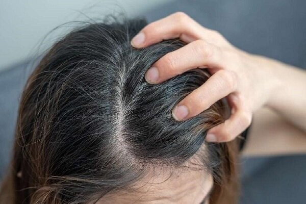 اگزما پوست سر چیست و چگونه درمان می شود؟