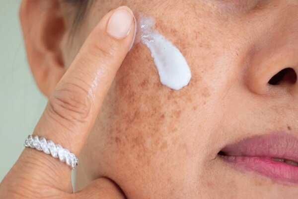 هشدار از سوختگی های پنهان خورشید مراقبت کنید - آژانس خبری مهر | اخبار ایرانی و جهانی