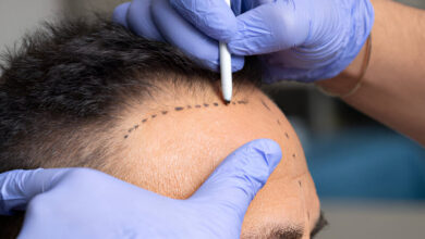 کاشت مو در شیراز