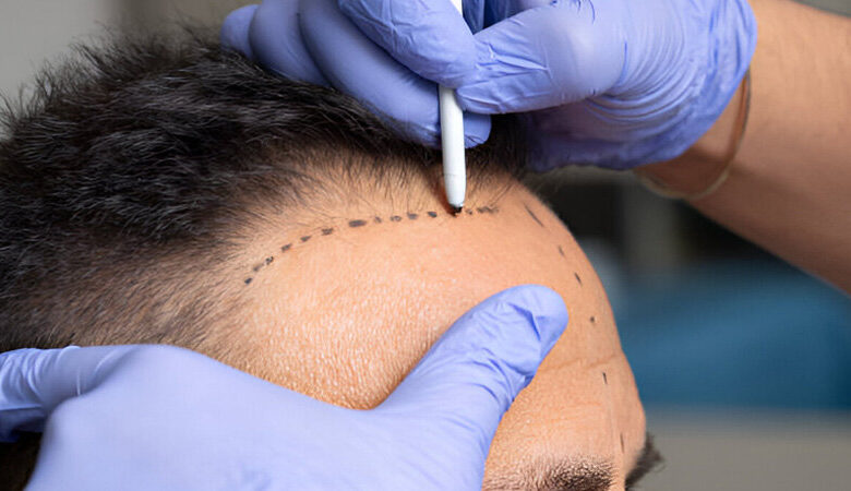 کاشت مو در شیراز