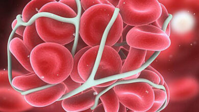 هموفیلی را بیشتر بشناسیم، از علائم تا کنترل بیماری
