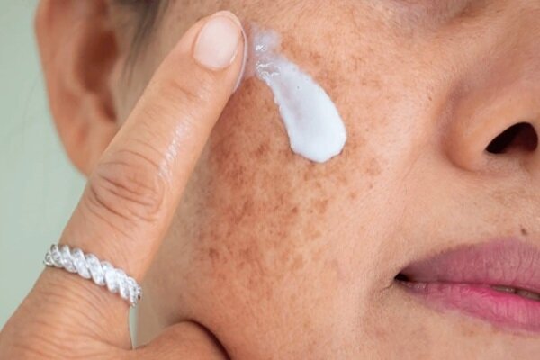 هشدار؛ مراقب سوختگی‌های پنهان آفتاب باشید