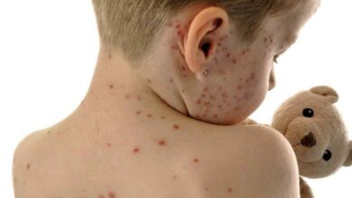 واکسیناسیون سرخک در جهان/ کدام کشورها سرخک را از بین برده اند؟/ وضعیت ایران