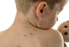 مدل سازی ایران برای کشورهای همسایه در حذف سرخک