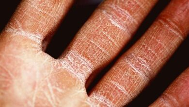 &quot;آلودگی هوا&quot; عامل تشدید اگزما در بزرگسالان