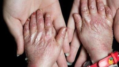 سهمیه تابستان پانسمان‌های تخصصی به خانه EB تحویل شد