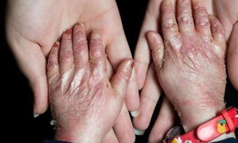 سهمیه تابستان پانسمانهای تخصصی به خانه EB تحویل شد