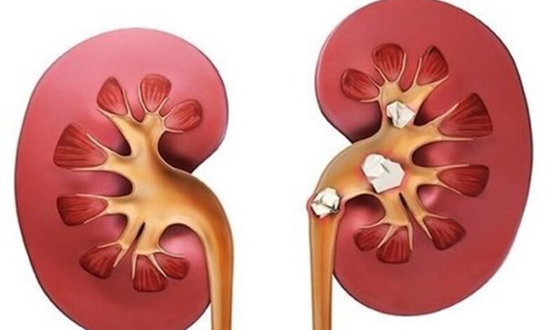 علائم سنگ کلیه؛ چه افرادی بیشتر در معرض ابتلا هستند؟