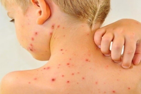 بالاترین سطح سرخک در ایالات متحده از سال 6 - آژانس خبری مهر | اخبار ایرانی و جهانی