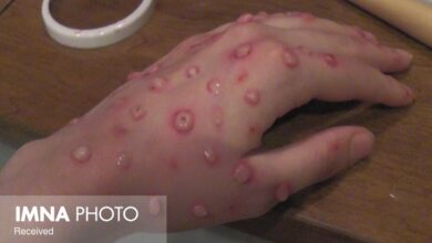 آیا ویروس آبله به زونا مرتبط است؟