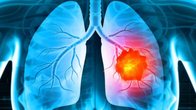 دلایل سرطان ریه در بین افراد غیر سینما چیست؟