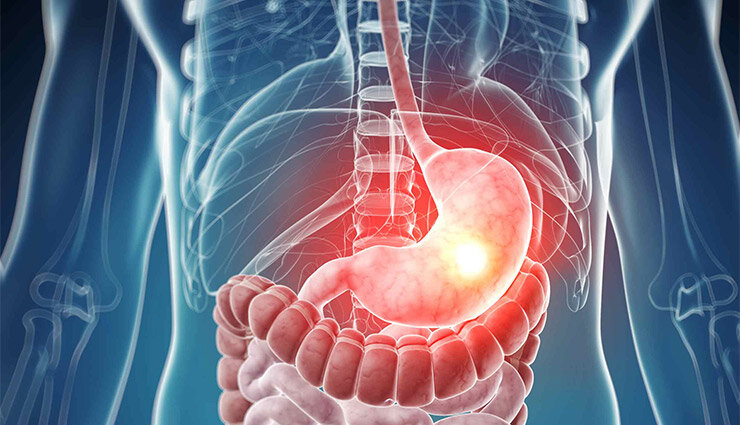 ۷۶ درصد سرطان‌های معده ناشی از این باکتری پنهان است