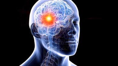 برای دانستن شایع ترین علت خونریزی مغز