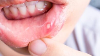 درمان سریع آفات خوراکی / برای آفت دهان؟ + درمان سریع آفت دهان با دارو