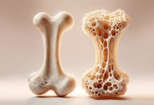 عوامل مؤثر بر پوکی استخوان