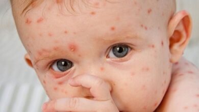 آبله در بزرگسالان ؛ بیماری شدیدتر با عوارض خطرناک تر - آژانس خبری مهر | اخبار ایرانی و جهانی